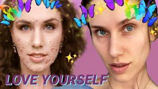 How To Love Yourself When You Have Acne  -  Acne Positivity